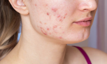 Natural adult acne skin care tips