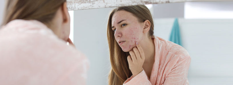 How to use witch hazel for adult acne