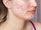 woman with adult acne