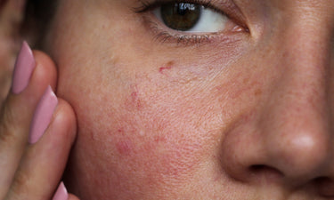 Anti-redness skin care: serum & moisturiser