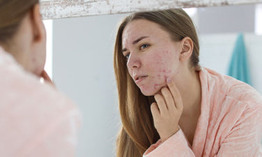 How to use witch hazel for adult acne
