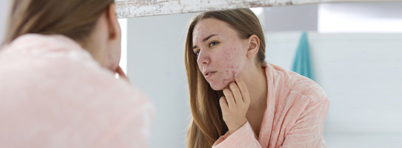 How to use witch hazel for adult acne image
